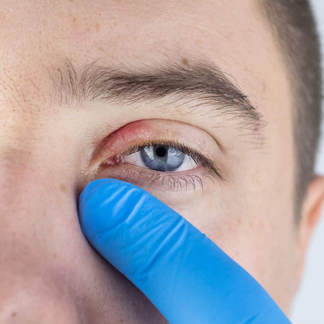 Oftalmopediatría