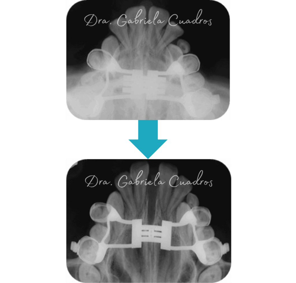 Ortodoncia en Lima - Clinica Alinea