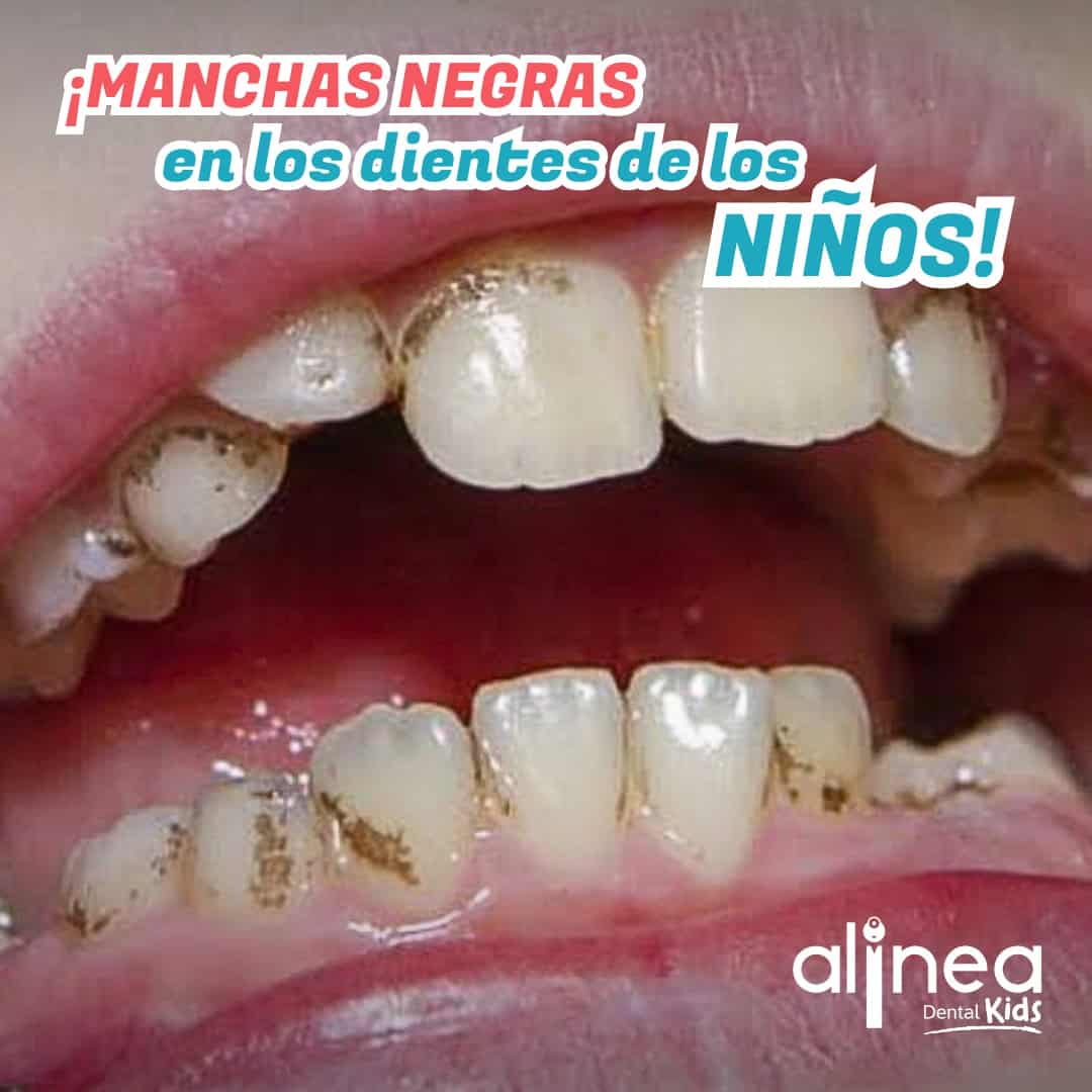 Manchas negras en los dientes de los niños