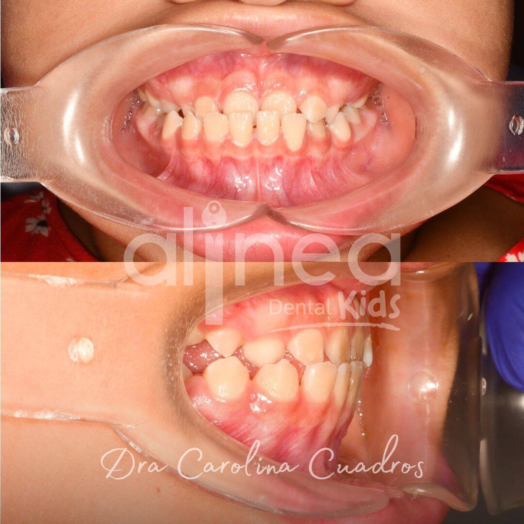 Mordida cruzada anterior - Dra Carolina Cuadros