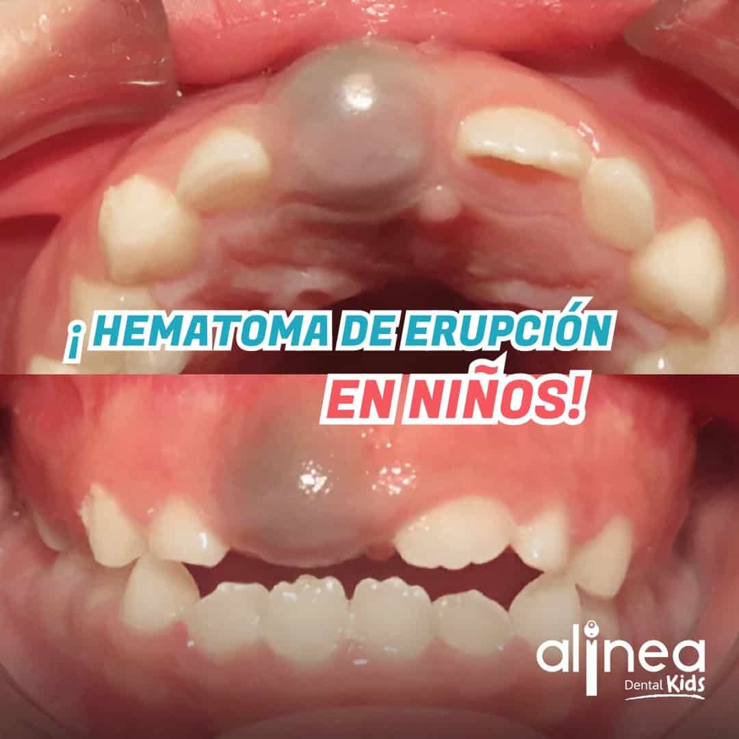 Hematoma de Erupción dental en Niños