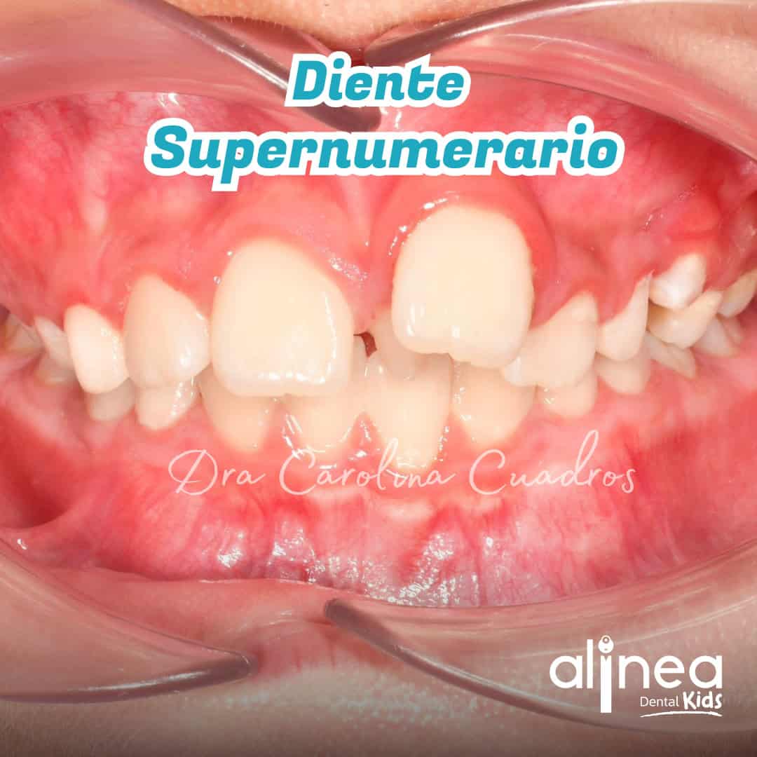Dientes supernumerarios - Dra Carolina Cuadros
