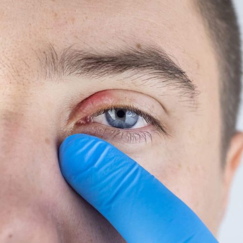 Oftalmopediatría