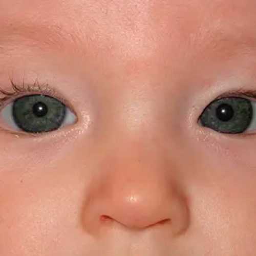 Oftalmología para niños
