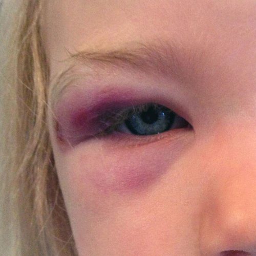 Accidentes oculares