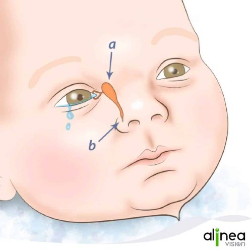 Oftalmología pediatrica